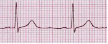 ECG con trazado de actividad eléctrica sin pulso