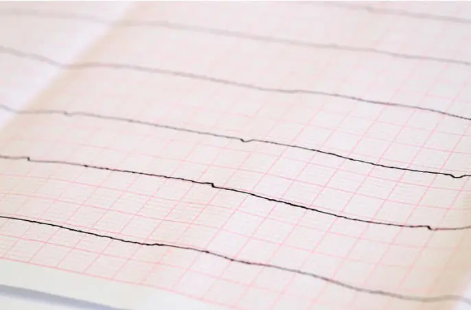ECG con trazado de asistolia