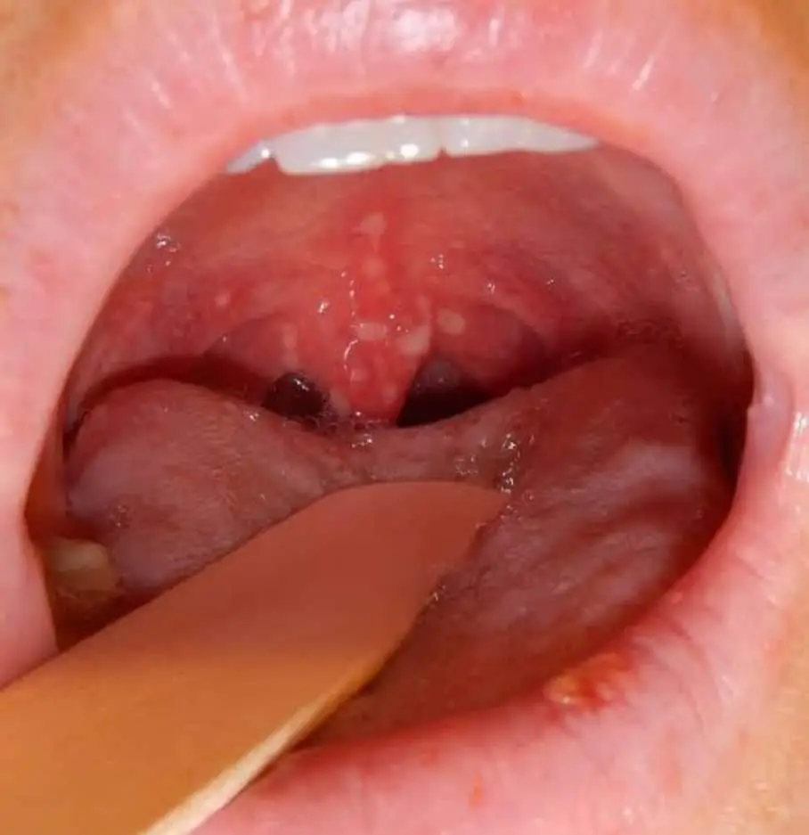 Imagen de manchas de Koplik en la mucosa oral, un signo característico del sarampión