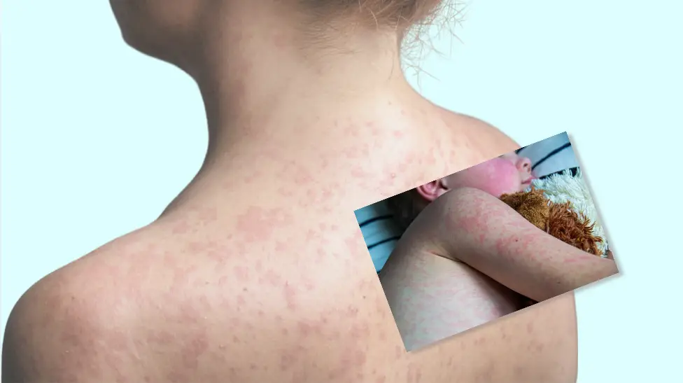 Composición de imágenes de exantema compatible con sarampión en una persona adulta y en un niño